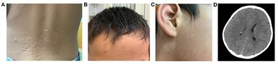 Brain Proteomic Profiling in Intractable Epilepsy Caused by TSC1 Truncating Mutations: A Small Sample Study